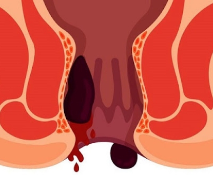 Bệnh trĩ gây nên biến chứng gì ?